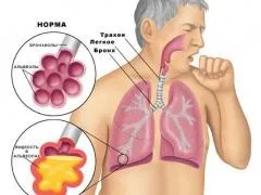 Реабілітація після пневмонії (реабілітація) Реабілітація після пневмонії
