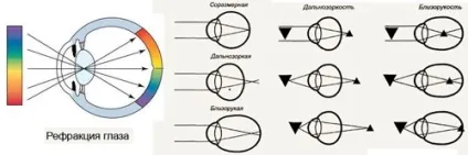 Рефракція ока визначення, порушення, види і аномалії (аномалії) Рефракція ока визначення, порушення, види і аномалії