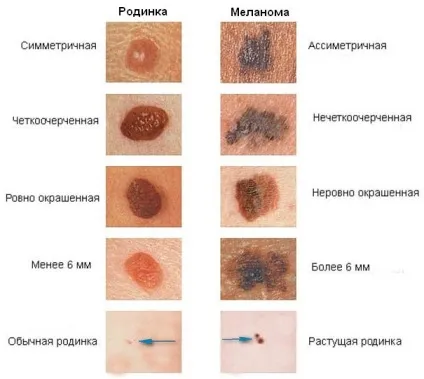 Родимка на грудині у жінок небезпечно, необхідність видалення (родимка на грудях) Родимка на грудині у жінок небезпечно, необхідність видалення