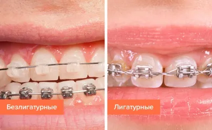 Самолігуючі брекети без лігатури (брекет) Самолігуючі брекети без лігатури