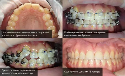 Самолігуючі брекети без лігатури (лінгвальний) Самолігуючі брекети без лігатури