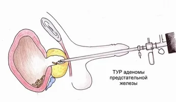 Сегодя печіння в простаті - вже не вирок (вражає передміхурову залозу) Сегодя печіння в простаті - вже не вирок
