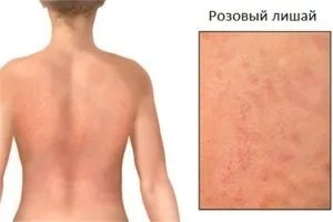 Симптоми і лікування рожевого лишаю у людини (людини) Симптоми і лікування рожевого лишаю у людини