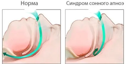 Синдром Штейна Левенталя - ознаки по зовнішності жінки (жінки) Синдром Штейна Левенталя - ознаки по зовнішності жінки