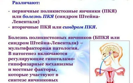 Синдром Штейна Левенталя - ознаки по зовнішності жінки (синдром) Синдром Штейна Левенталя - ознаки по зовнішності жінки