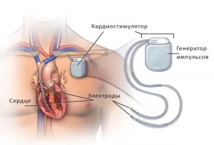 Синдром слабкості синусового вузла симптоми, діагностика та лікування (вузла) Синдром слабкості синусового вузла симптоми, діагностика та лікування