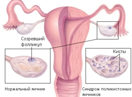Синдром Штейна-Левенталя відмітні ознаки (синдром) Синдром Штейна-Левенталя відмітні ознаки