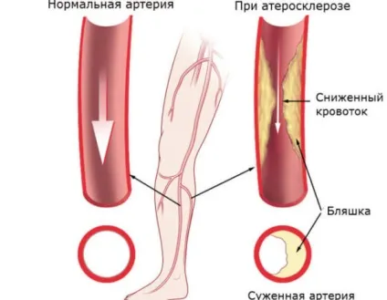 Синдром Штейна-Левенталя відмітні ознаки (відмінні) Синдром Штейна-Левенталя відмітні ознаки