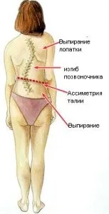 Сколіоз хребта види, небезпеки і наслідки (наслідки) Сколіоз хребта види, небезпеки і наслідки
