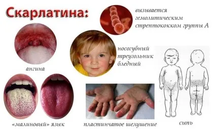 Скарлатина основні симптоми, лікування і профілактика (основні) Скарлатина основні симптоми, лікування і профілактика