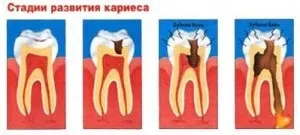 Стадії карієсу зубів