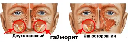 Стадії і різновиди гаймориту (верхнечелюстного синуситу) (синуситу) Стадії і різновиди гаймориту (верхнечелюстного синуситу)
