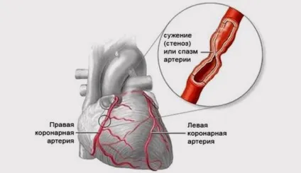 Стенокардія Принцметала (варіантна, спонтанна) причини, симптоми і лікування