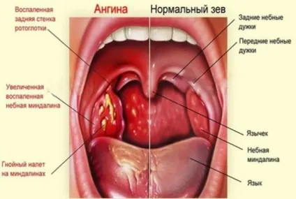 Стафілококова ангіна у дітей і дорослих симптоми, лікування антибіотиками (стрептококова ангіна флемоксин) Стафілококова ангіна у дітей і дорослих симптоми, лікування антибіотиками