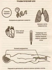 Травматична хвороба поняття, клініка, діагностика, лікування (хвороба) Травматична хвороба поняття, клініка, діагностика, лікування