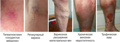 Трофічні виразки на ногах - фото і стадії розвитку хвороби
