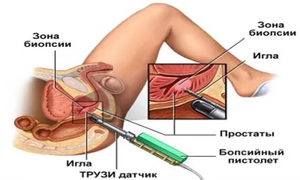 ТРУЗІ передміхурової залози що це, як роблять і підготовка до процедури (ТРУЗІ) ТРУЗІ передміхурової залози що це, як роблять і підготовка до процедури