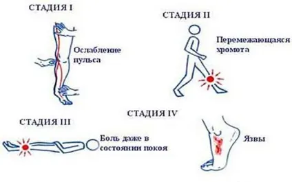 Трофічні виразки на ногах - фото і стадії розвитку хвороби