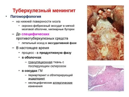 Туберкульозний менінгіт, симптоми і лікування, діагностика, як передається (туберкульозний) Туберкульозний менінгіт, симптоми і лікування, діагностика, як передається