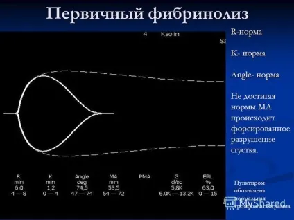 Тромбоеластограмма (тег) що це таке, trombanet