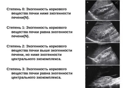 Ущільнення ЧЛС обох нирок