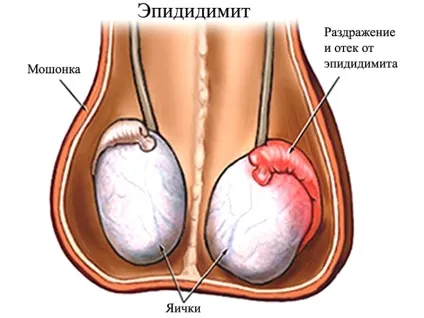 збільшення яєчка