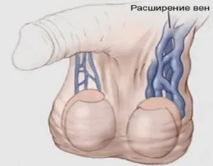 Варикоцеле яєчок у чоловіків що це таке і як виглядає захворювання на фото, історія недуги, а також (варикоцеле у чоловіків це) Варикоцеле яєчок у чоловіків що це таке і як виглядає захворювання на фото, історія недуги, а також