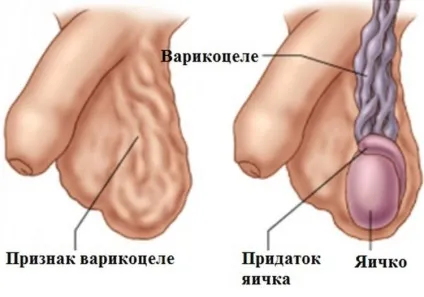 Варикоцеле яєчок у чоловіків що це таке і як виглядає захворювання на фото, історія недуги, а також (варикоцеле у чоловіків це) Варикоцеле яєчок у чоловіків що це таке і як виглядає захворювання на фото, історія недуги, а також