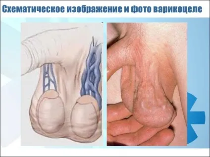 Варикоцеле яєчок у чоловіків що це таке і як виглядає захворювання на фото, історія недуги, а також (варикоцеле яєчка) Варикоцеле яєчок у чоловіків що це таке і як виглядає захворювання на фото, історія недуги, а також
