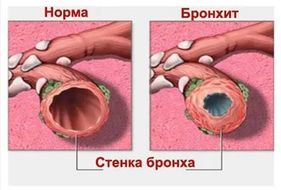 Димедрол і алкоголь наслідки змішування і смертельна доза (димедрол) Димедрол і алкоголь наслідки змішування і смертельна доза