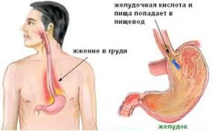 Дієта при печії лікувальний меню, поради та рекомендації лікарів (дієта печія лікувальна меню відгуки результати) Дієта при печії лікувальний меню, поради та рекомендації лікарів