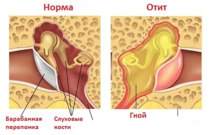 Дифузний зовнішній отит симптоми і лікування у дорослих, фото (отит) Дифузний зовнішній отит симптоми і лікування у дорослих, фото