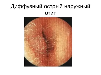 Дифузний зовнішній отит симптоми і лікування у дорослих, фото (зовнішній) Дифузний зовнішній отит симптоми і лікування у дорослих, фото