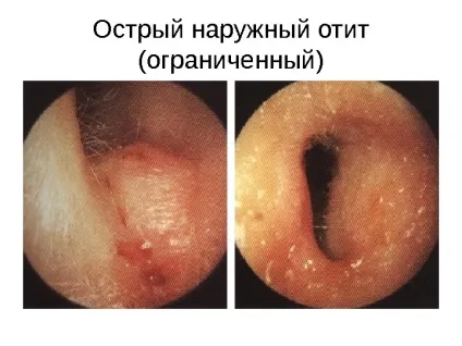 Дифузний зовнішній отит симптоми і лікування у дорослих, фото (отит) Дифузний зовнішній отит симптоми і лікування у дорослих, фото