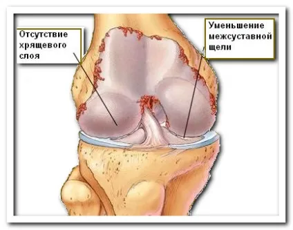 Діагностика і лікування артрозу колінного суглоба (артрозу) Діагностика і лікування артрозу колінного суглоба