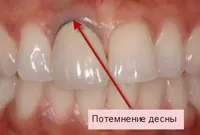 Види металокераміки і металокерамічних коронок - які краще, недоліки і протипоказання (коронок) Види металокераміки і металокерамічних коронок - які краще, недоліки і протипоказання