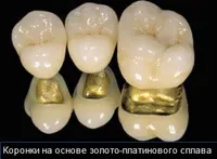 Види металокераміки і металокерамічних коронок - які краще, недоліки і протипоказання (види) Види металокераміки і металокерамічних коронок - які краще, недоліки і протипоказання
