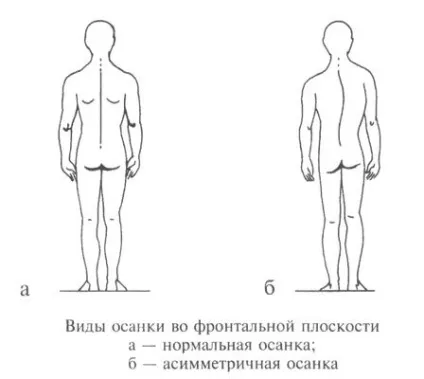 Види порушення постави у дітей і дорослих - характеристика, фото (дітей) Види порушення постави у дітей і дорослих - характеристика, фото