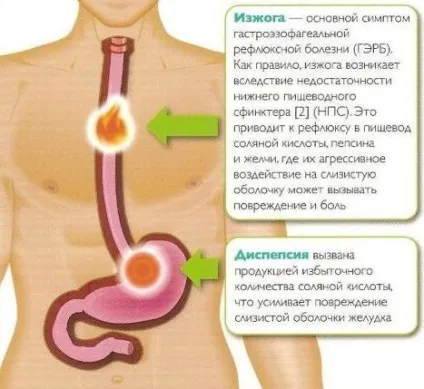 Викид шлункового соку в гортань неприємний і дуже небезпечна недуга (соку) Викид шлункового соку в гортань неприємний і дуже небезпечна недуга