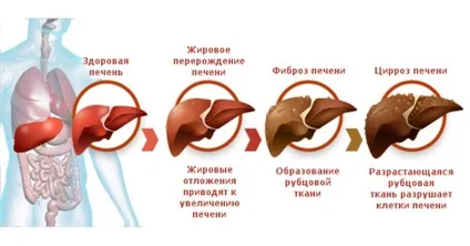 Вплив нікотину на печінку може коштувати життя (печінка курця) Вплив нікотину на печінку може коштувати життя