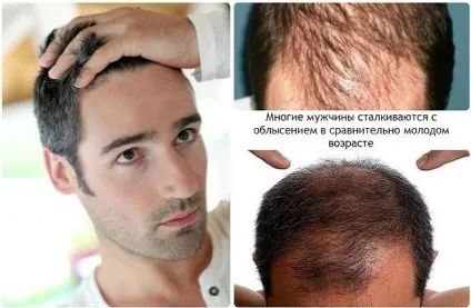Випадання волосся у чоловіків у молодому віці причини і лікування облисіння у чоловіків (молодому) Випадання волосся у чоловіків у молодому віці причини і лікування облисіння у чоловіків