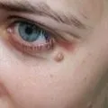 Запалення папіломи - фото, причини, ускладнення, лікування (фото) Запалення папіломи - фото, причини, ускладнення, лікування