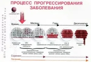 Запалення папіломи - фото, причини, ускладнення, лікування (фото) Запалення папіломи - фото, причини, ускладнення, лікування