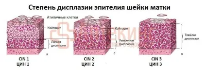 ВПЛ 16 типу у жінок - лікування, симптоми і діагностика (діагностика) ВПЛ 16 типу у жінок - лікування, симптоми і діагностика