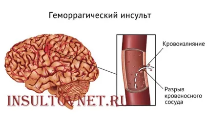 Відновлення після геморагічного інсульту прогноз і лікування (інсульту) Відновлення після геморагічного інсульту прогноз і лікування