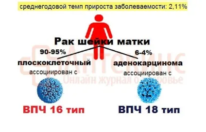 ВПЛ 16 типу у жінок - лікування, симптоми і діагностика (лікування) ВПЛ 16 типу у жінок - лікування, симптоми і діагностика