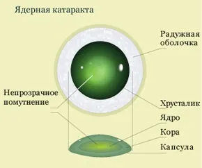 Ядерна катаракта очей у літніх людей і ускладнення хвороби, про хвороби очей (ядерна) Ядерна катаракта очей у літніх людей і ускладнення хвороби, про хвороби очей