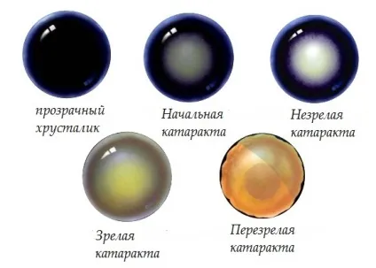Ядерна катаракта очей у пожілихі стадії і лікування (очей) Ядерна катаракта очей у пожілихі стадії і лікування