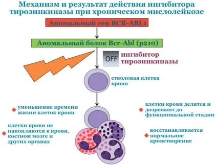 Хронічний мієлолейкоз - особливості даного виду раку крові, симптоми і правильна діагностика, (мієлолейкоз) Хронічний мієлолейкоз - особливості даного виду раку крові, симптоми і правильна діагностика,