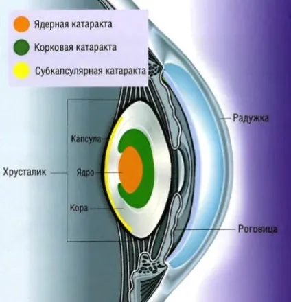 Ядерна катаракта очей у пожілихі стадії і лікування (очей) Ядерна катаракта очей у пожілихі стадії і лікування